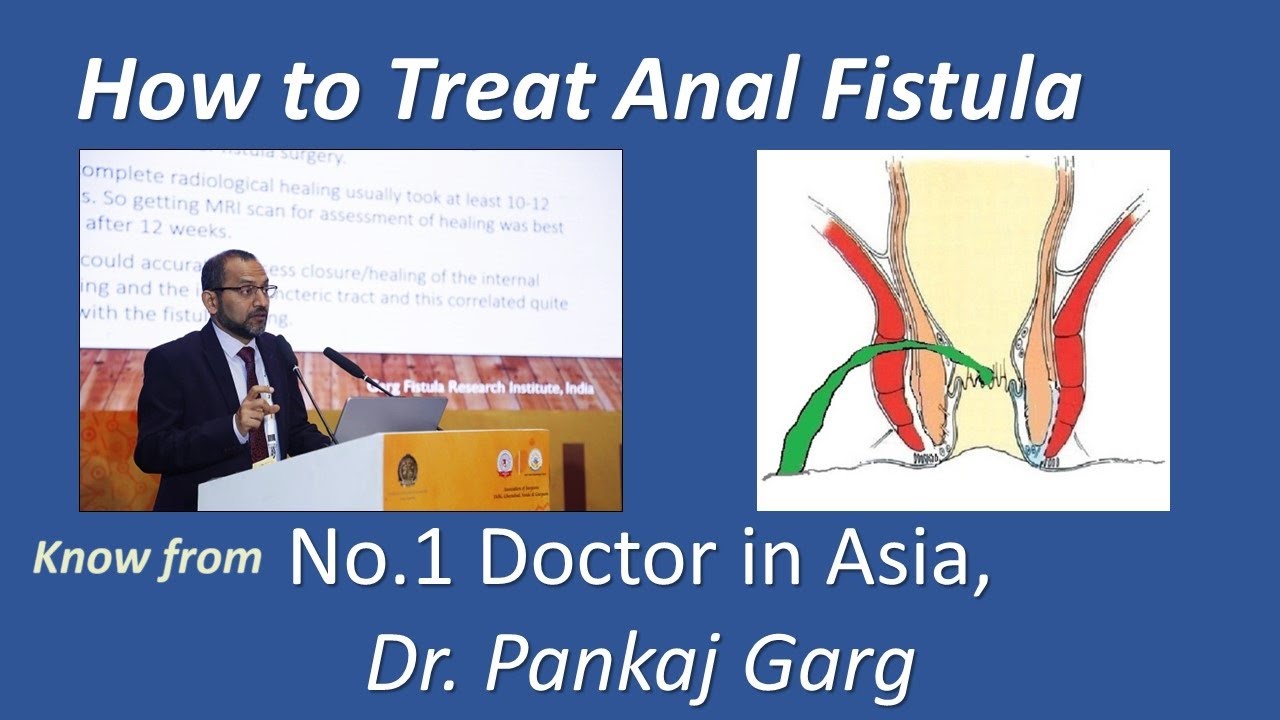 What is ANAL FISTULA? Know cause & successful treatment from Asia No. 1  Surgeon- Dr Pankaj Garg