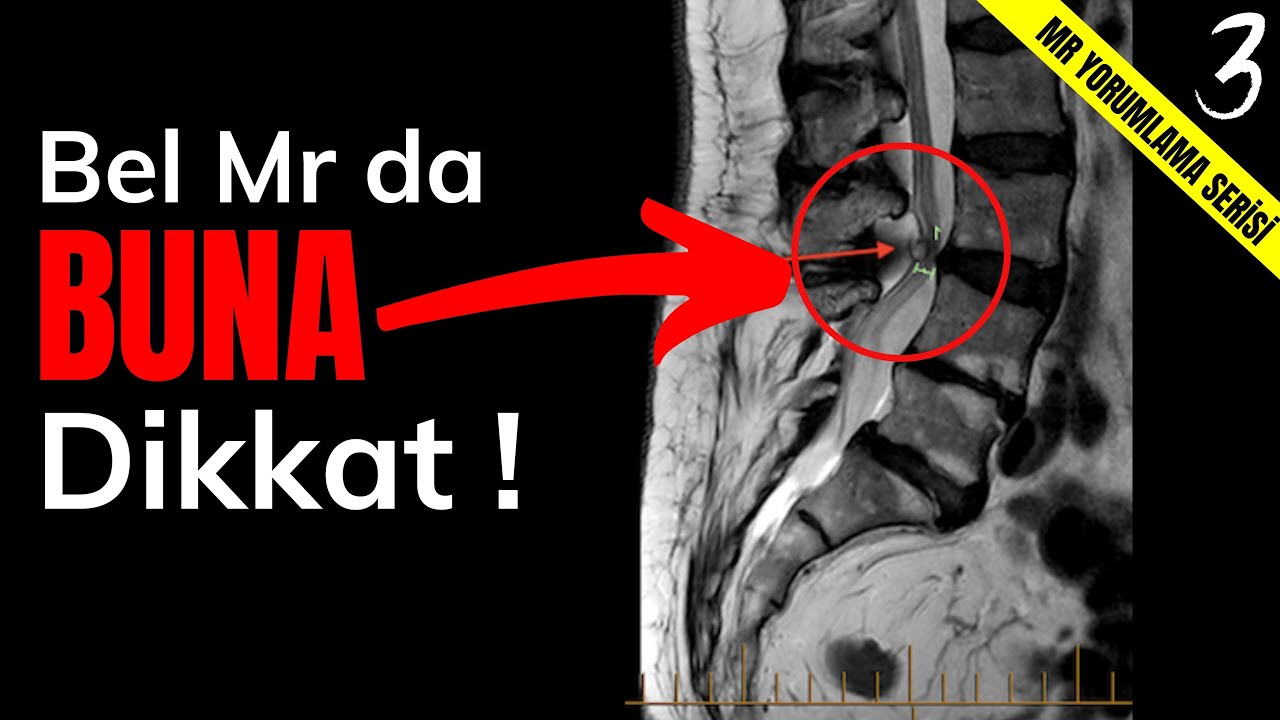 MR Yorumlama: Bel Fıtığı Belirtileri Taklit Eden Bu Rahatsızlığa Dikkat ! ''Lomber Sinoviyal Kist ''