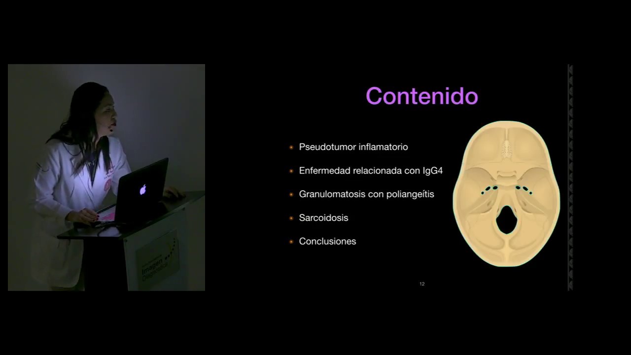 Pseudotumor y otras enfermedades inflamatorias no infecciosas de base de cráneo Dra. Karla Jonguitud