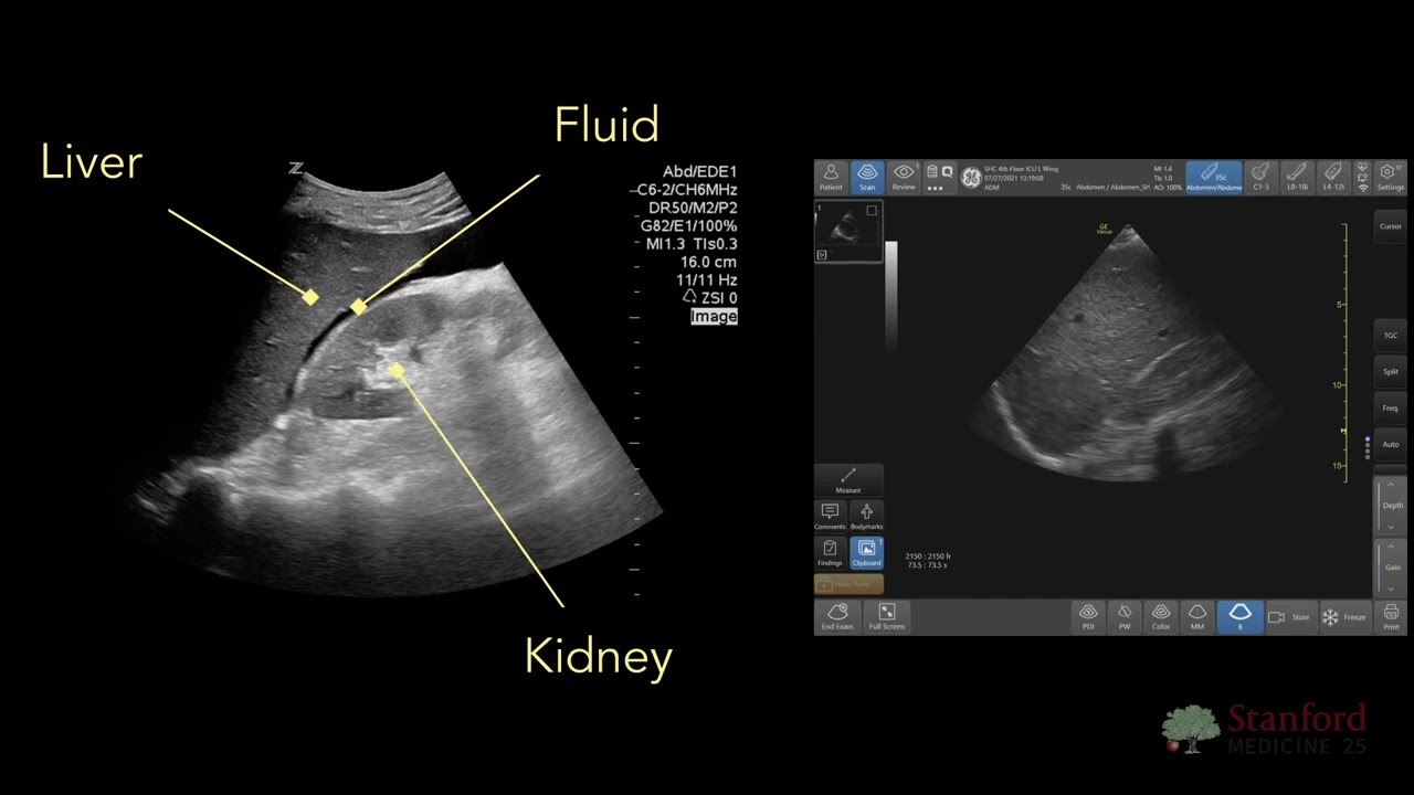 Point of Care Ultrasound for Ascites (POCUS)