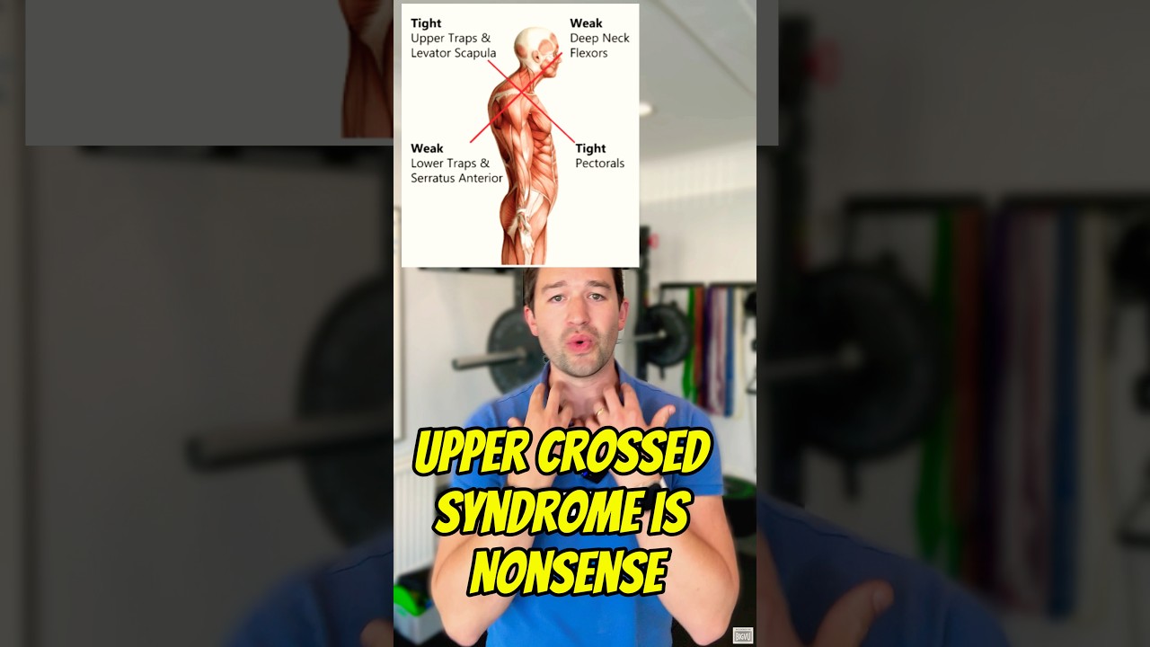 Upper Crossed Syndrome is Nonsense. Heres why.