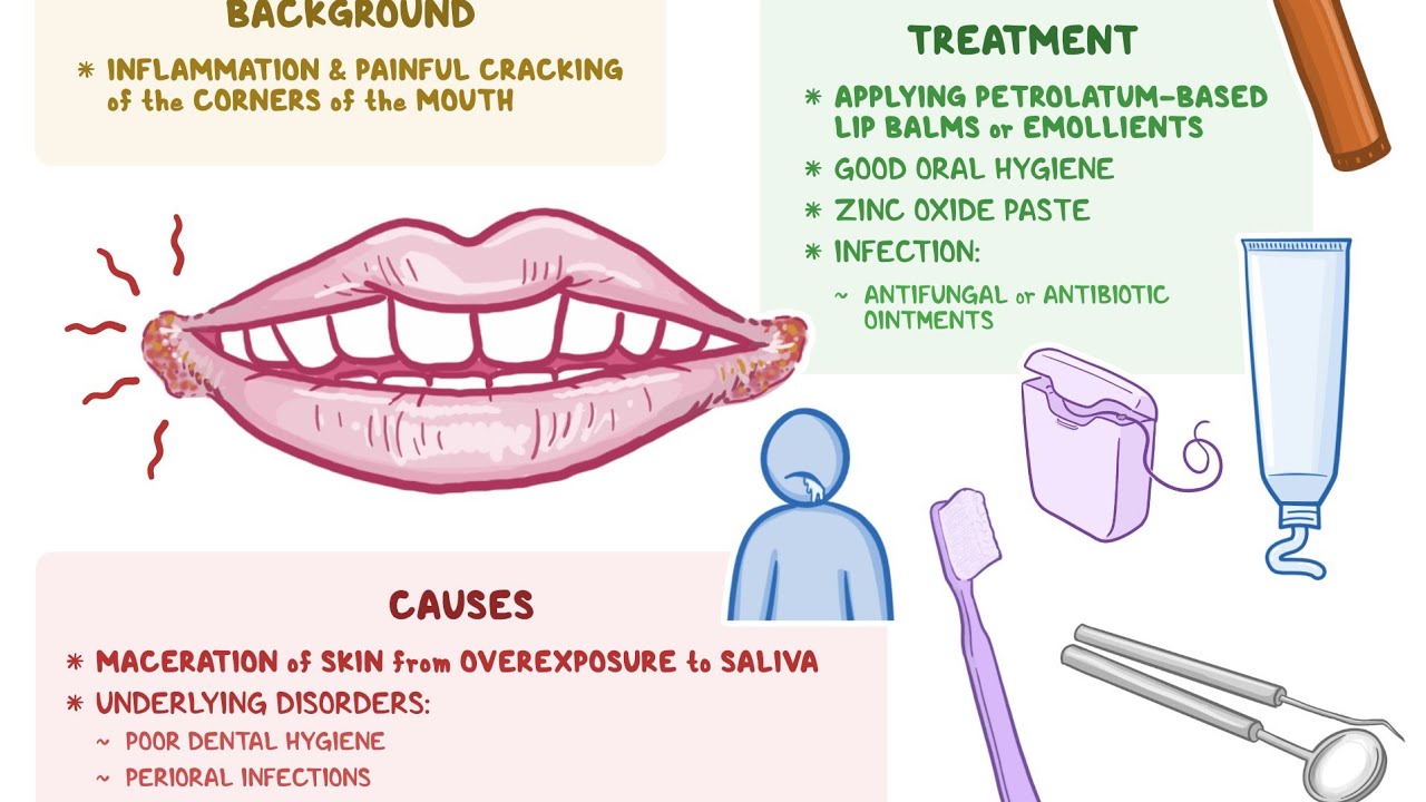 Angular cheilitis How to Recover and prevent! #angularchelitis #candida #bacterial #thrush #pain
