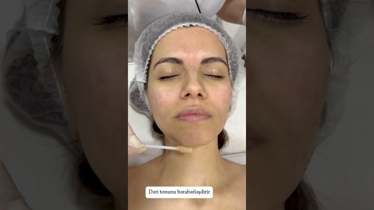 Piling (Chemical Peeling) #peel #piling #skincare