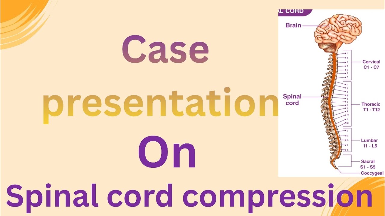 Case Presentation on Spinal cord compression case presentation nursing students !Case Study 