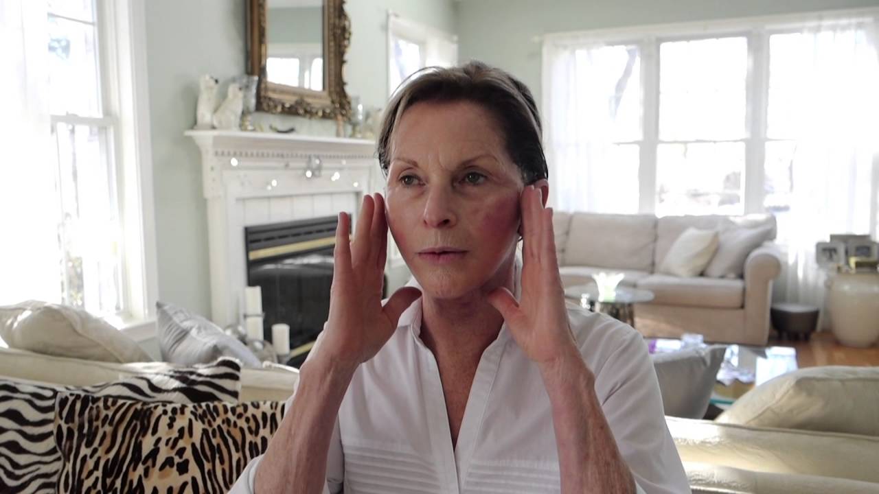 Paula 2 days after her Lower Face/Neck Lift: Min S. Ahn MD FACS