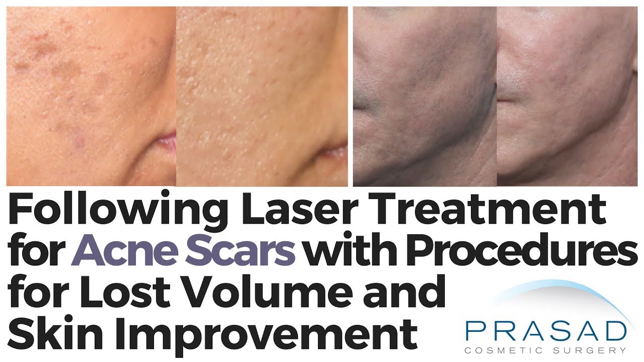 How Laser Treatment for Acne Scars can Benefit from Non-Laser Treatments Below the Skin