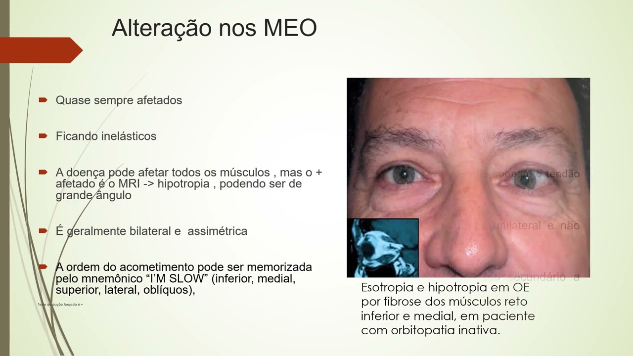 AULA 8 - programa estrabismo - ORBITOPATIA DE GRAVES AULA