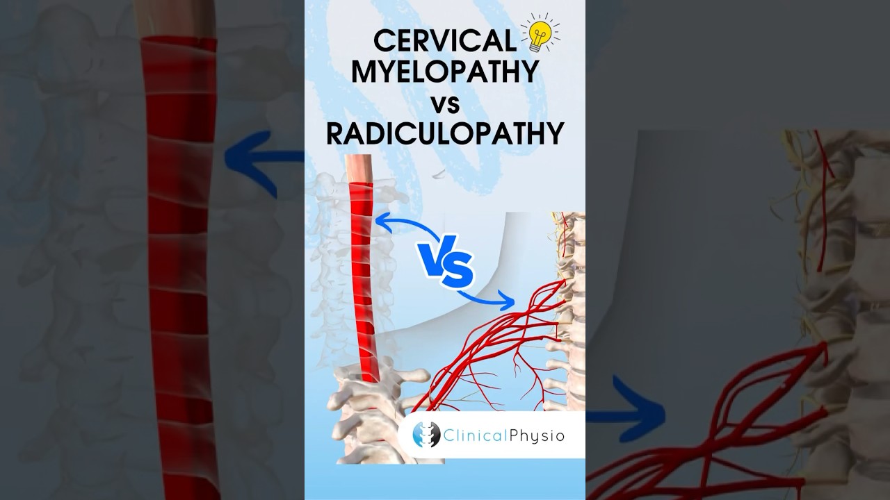 Cervical Radiculopathy vs Myelopathy #physiotherapy #physicaltherapy #medical