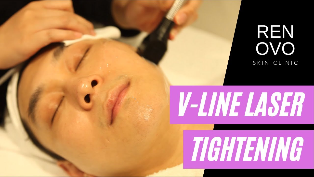Laser Skin Tightening! Get a V-Line Face | Renovo Skin Clinic