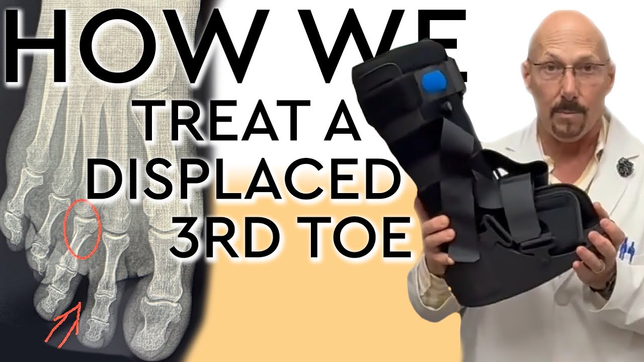 How We Treat A Displaced 3rd Toe