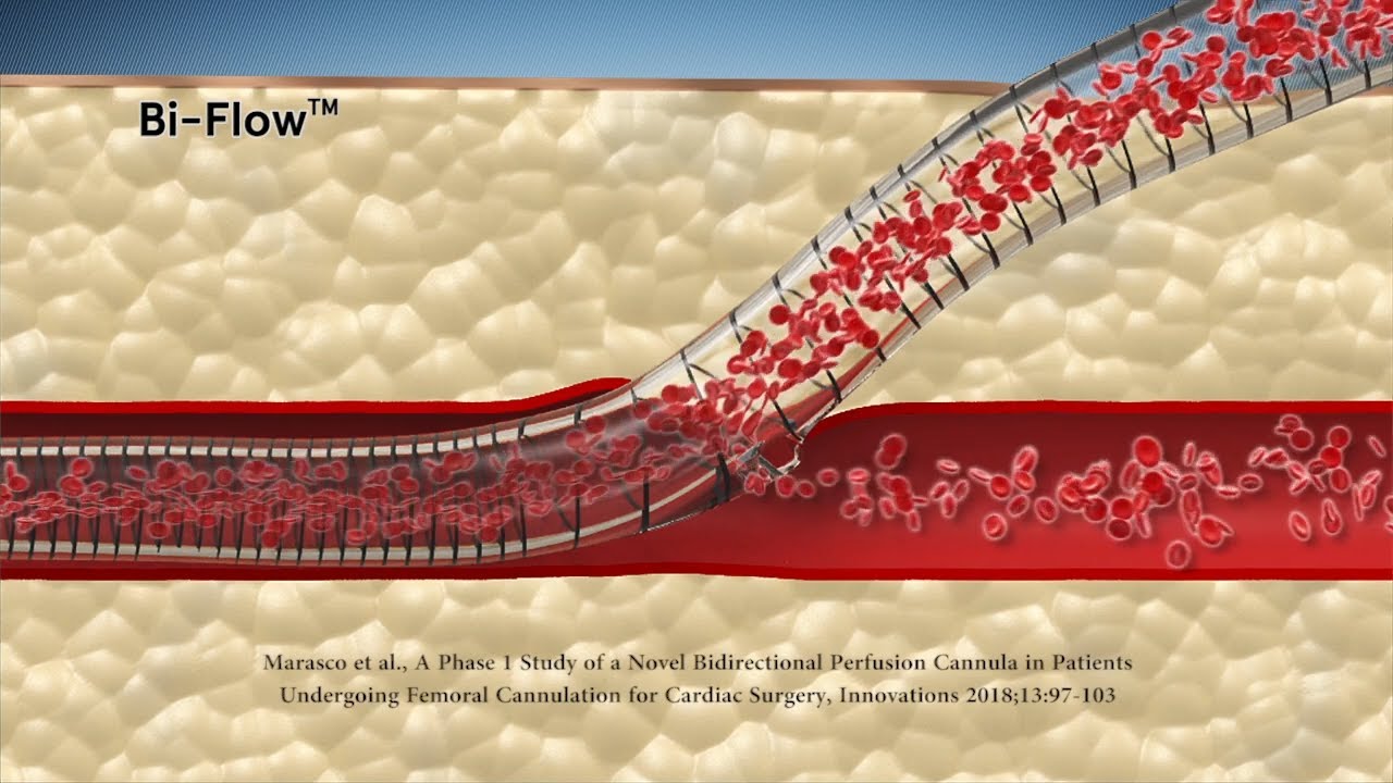Bi-Flow bi-directional cannula - Marketing version by Aarons CGI 3D animation studio Melbourne