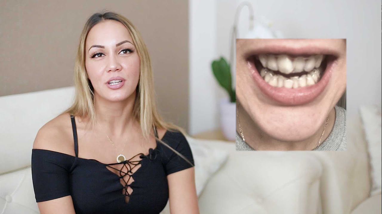 DR SMILE Stories: Zahnfehlstellung - Aylins Erfahrungen