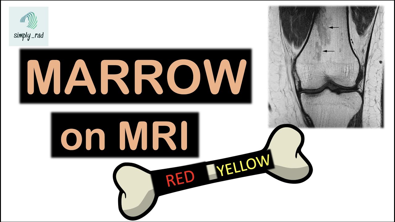 Marrow on MRI - simplified (1/2)