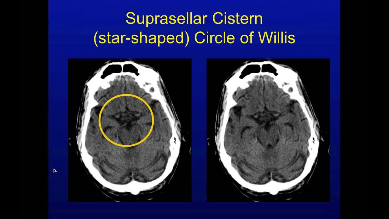 Head CT Interpretation Made Easy