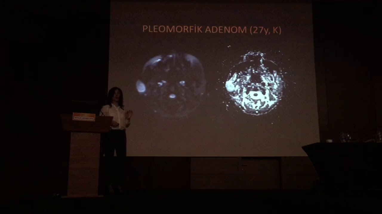 Tükürük Bezi Tümörlerinde Görüntüleme // Prof. Dr. Gül Hatipoğlu