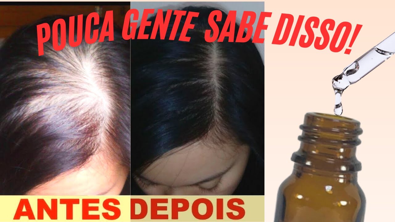 MELHOR QUE MINOXIDIL! FAZ CRESCER CABELO ATÉ NA TESTA E ACABA COM FALHAS #hairtutorial