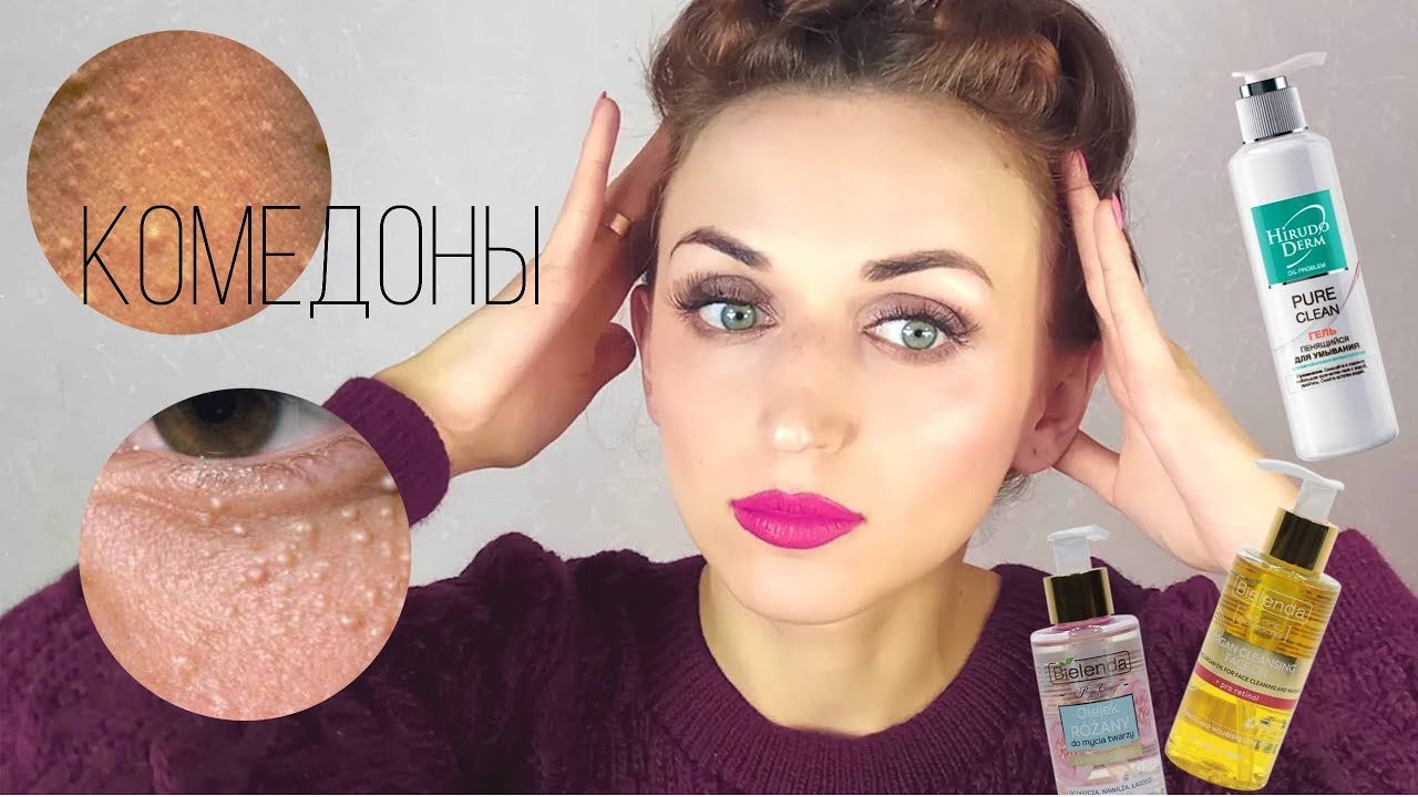 УЖАС который был 🔥  КОМЕДОНЫ #n.radetskaya