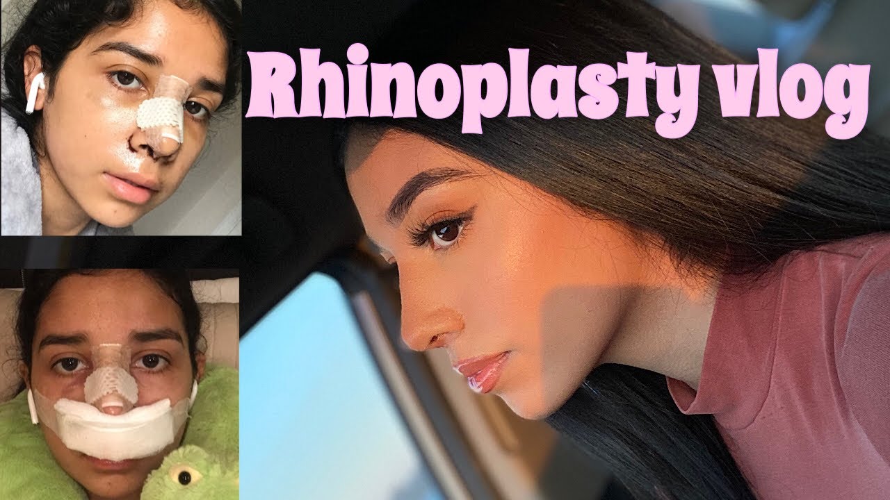 NOSE JOB VLOG! ( experience, cost, before and after)