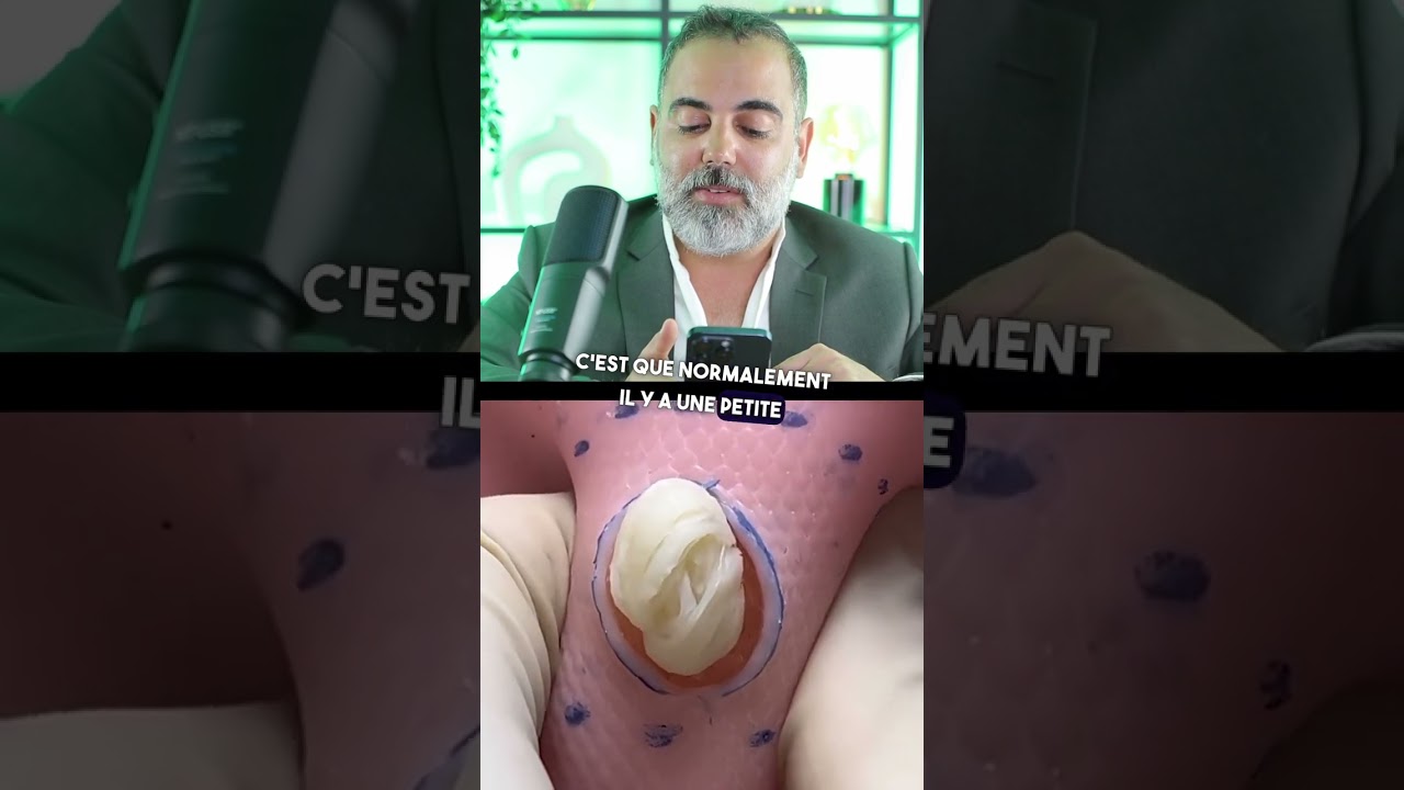 L'importance de retirer la paroi lors de l'excision d'un kyste