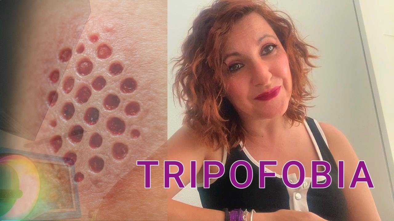 Tripofobia: Descubre el origen oculto de tu miedo
