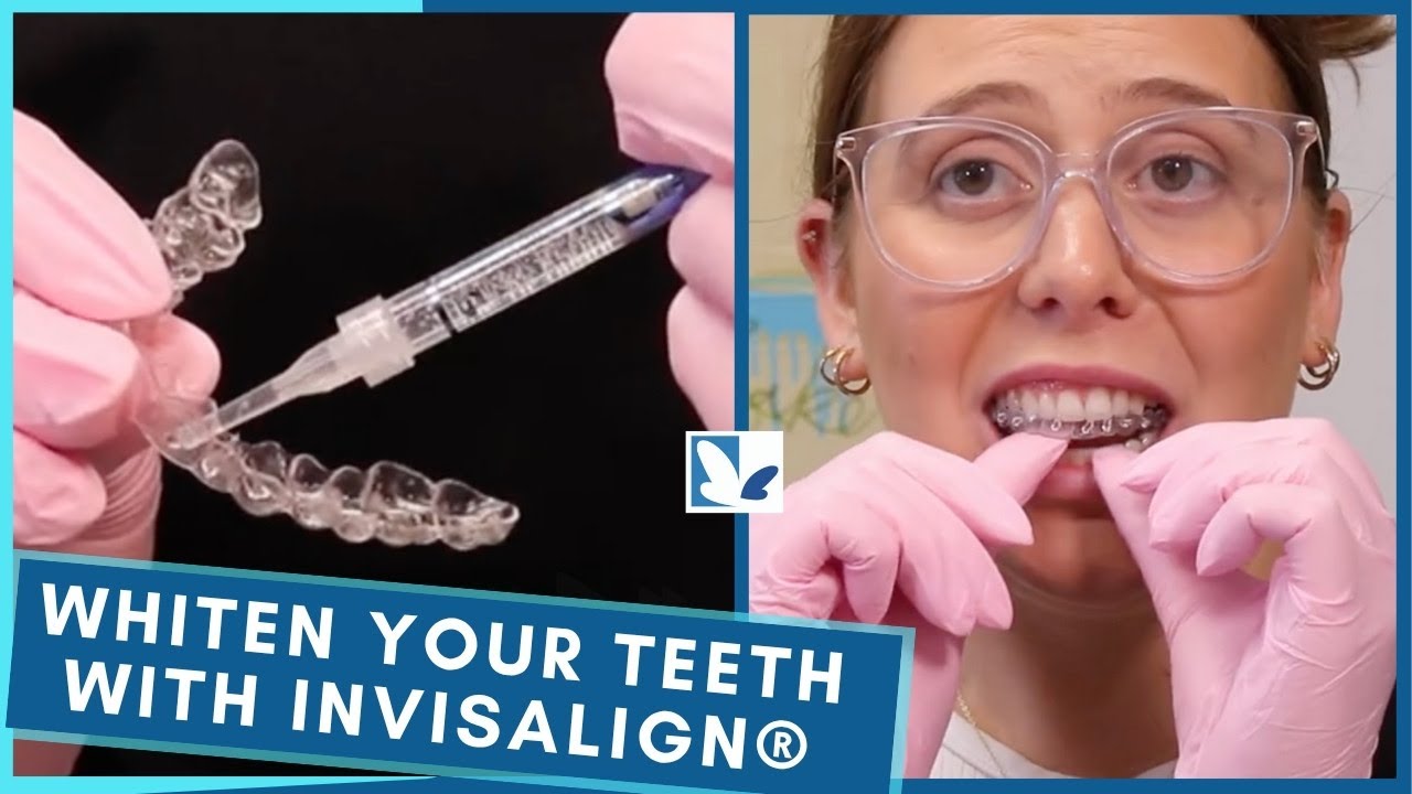 How to Whiten Teeth With Invisalign® Aligners?