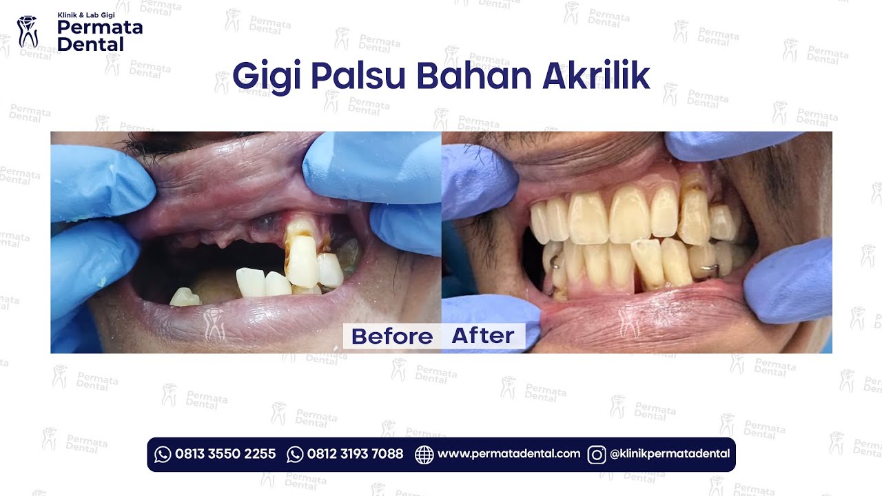 Proses Pemasangan Gigi Palsu Bahan Akrilik Rahang Atas & Bawah di Klinik Permata Dental