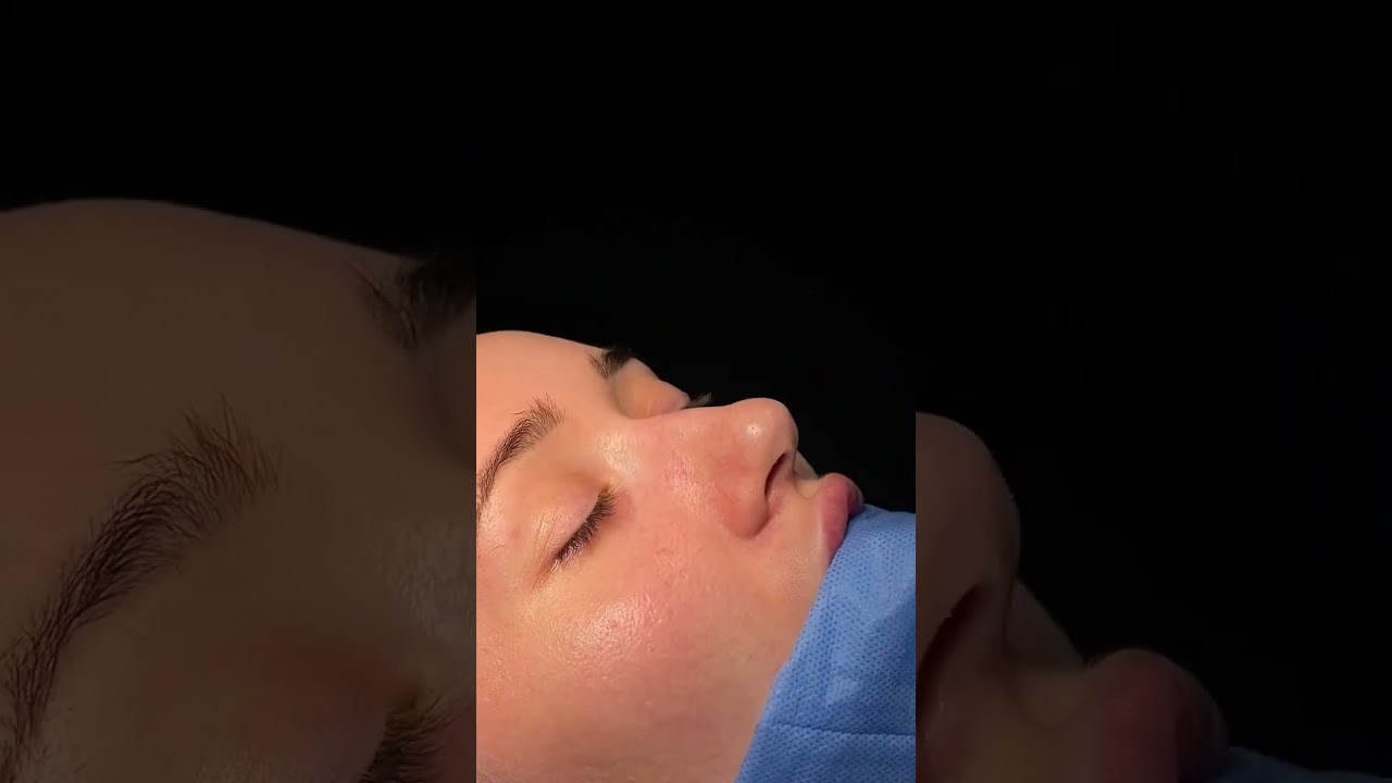 Ринопластика в Кишинёве #moldova #chisinau #altermed #surgery #rinoplastiechisinau