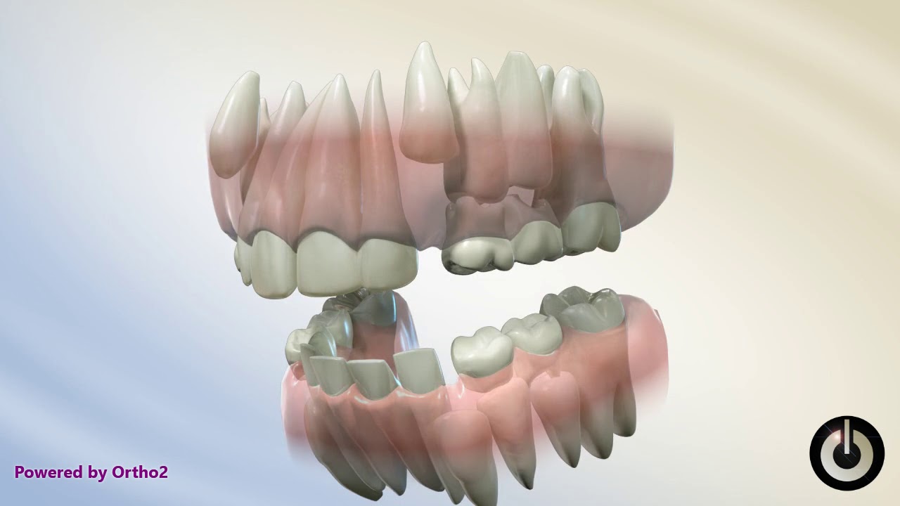 Serial Extraction | Dental Braces | Temecula Valley, CA