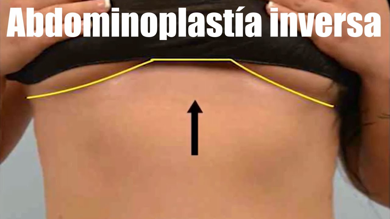 ABDOMINOPLASTÍA INVERSA 👙 ¿Cuándo, Cómo y Por Qué realizarla? 🤩 DR. ALBERTO CALVO QUIROZ