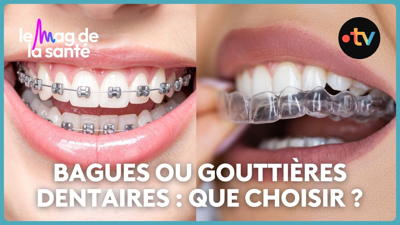 Appareils orthodontiques pour adultes : est-ce que ça fonctionne ?