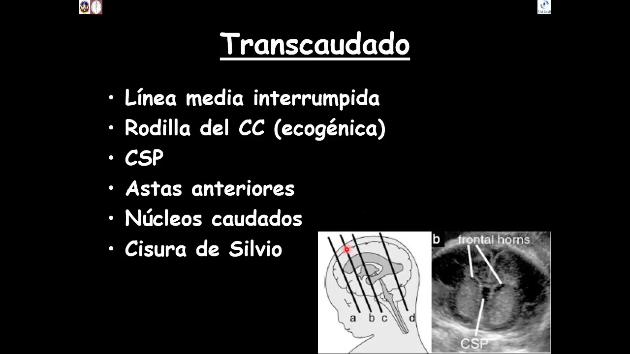 Ecografía del Sistema Nervioso Central fetal FACIL. Parte 1
