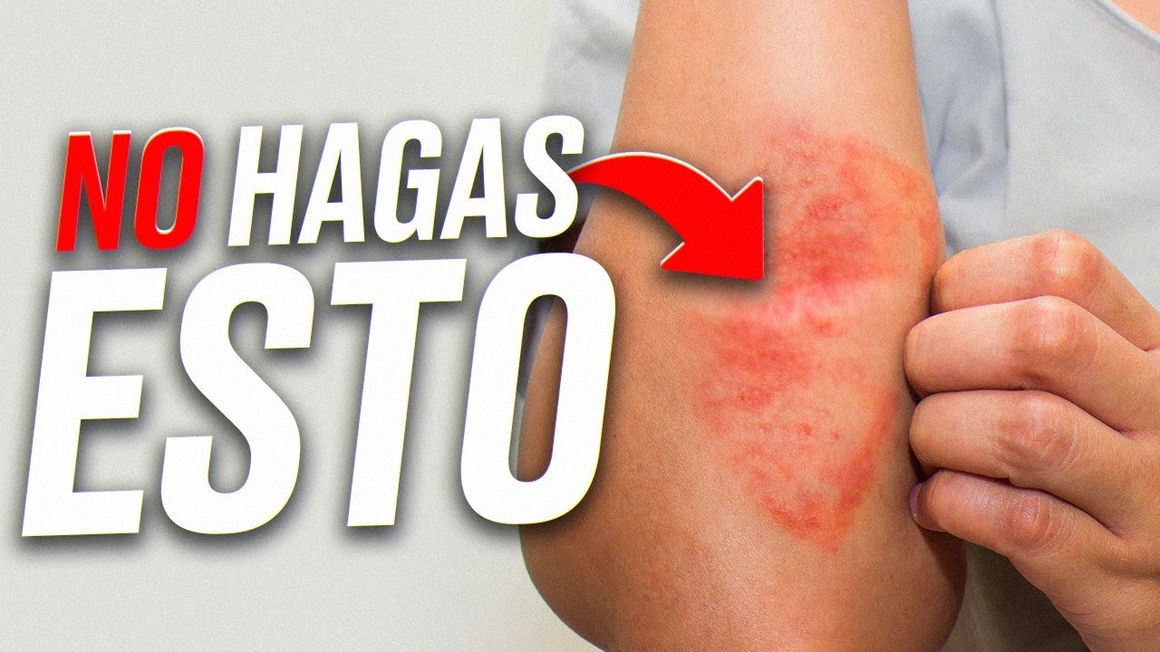 ECCEMAS | A qu&eacute; se deben, d&oacute;nde aparecen, qu&eacute; tipos hay y cuidados para mitigar sus efectos