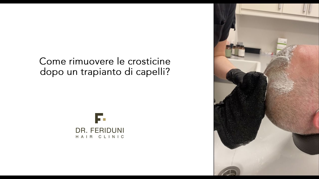 Come rimuovere le crosticine dopo un trapianto di capelli