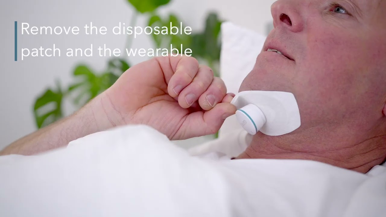 Using Genio as the CPAP alternative for Obstructive Sleep Apnea
