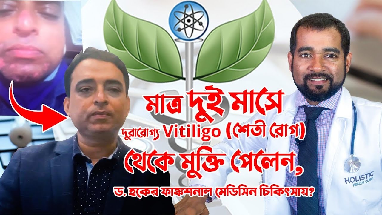 মাত্র দুই মাসে দুরারোগ্য Vitiligo (শেতী রোগ) থেকে মুক্তি পেলেন, ড. হকের ফাঙ্কশনাল মেডিসিন চিকিৎসায়?