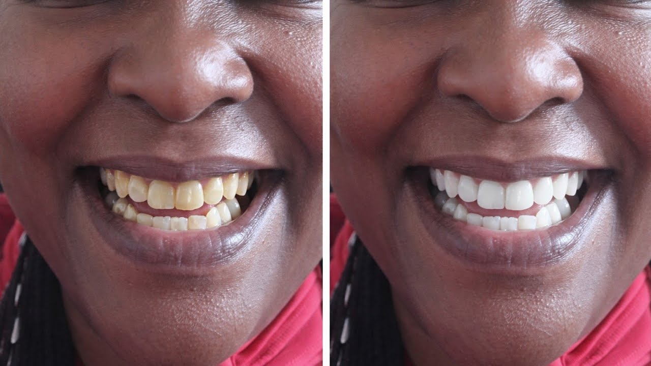 In 2 minutes I removed 20 years of stain and tartar from my teeth!!results will shock you