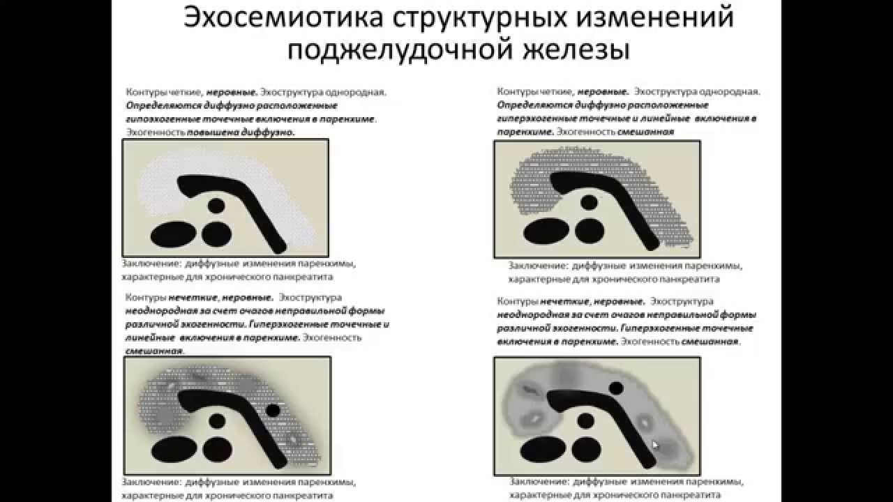 Эхосемиотика эхоструктурных изменений поджелудочной железы