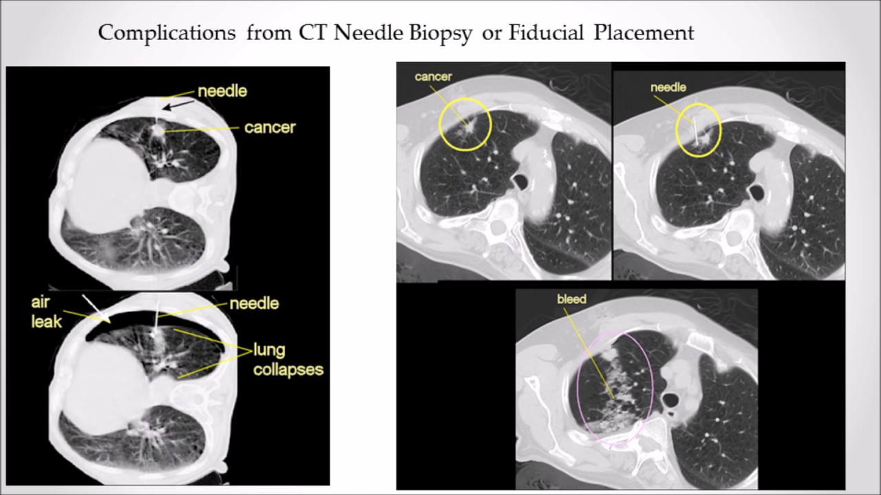 SBRT for Lung Cancer