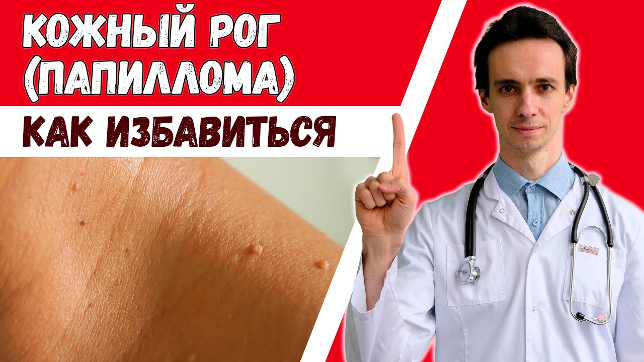 Папилломы (акрохордон, кожный рог). 👉 Откуда берутся и как избавиться? 🩺