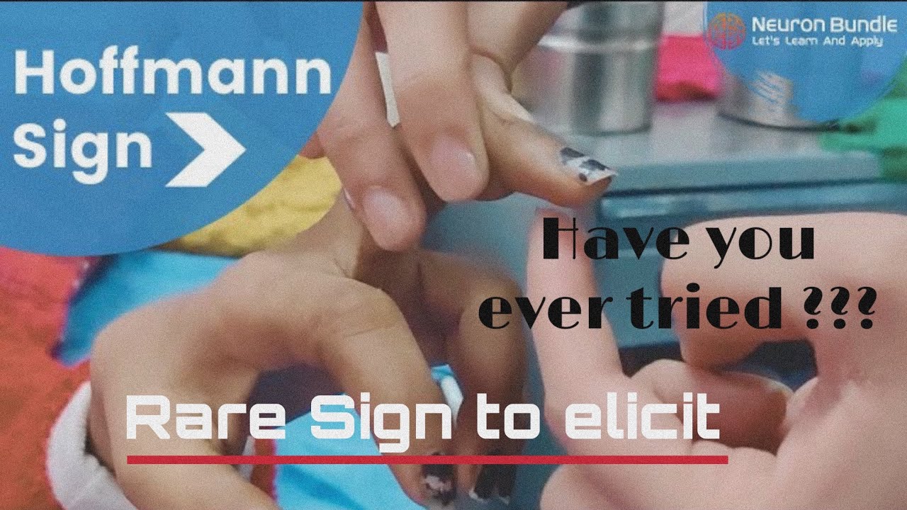 Hoffman&rsquo;s Test  or Tr&ouml;mner's reflex : upper limb babinski sign #positive   #UMNlesion #neurology