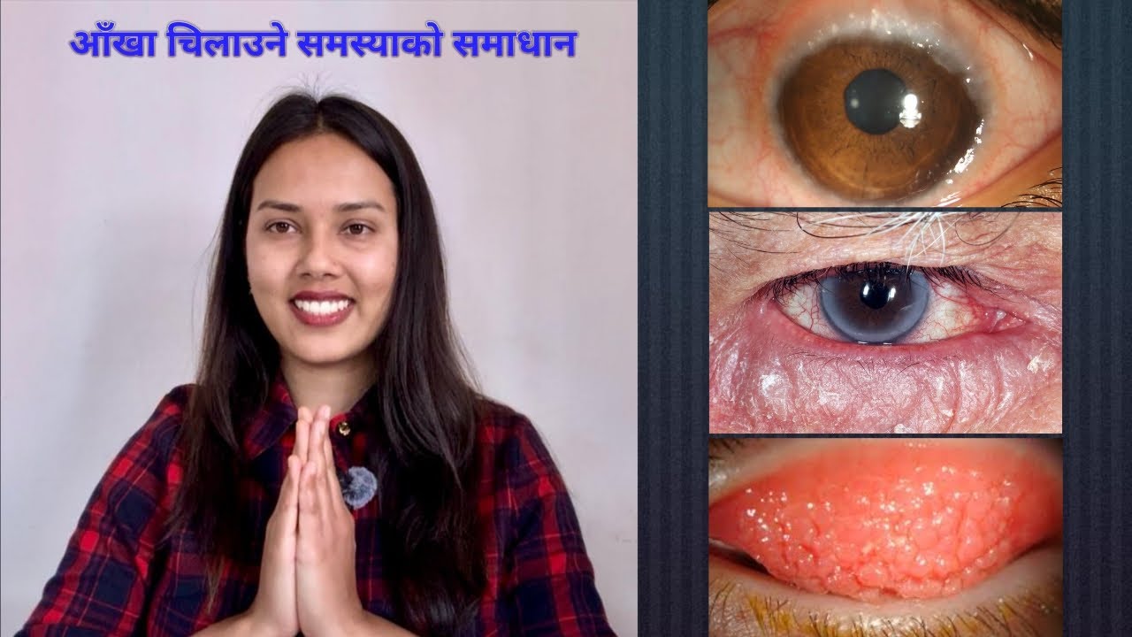 आँखामा हुने एलर्जिको कारण र समाधान | #nepalieyedoctor #eyeallergy