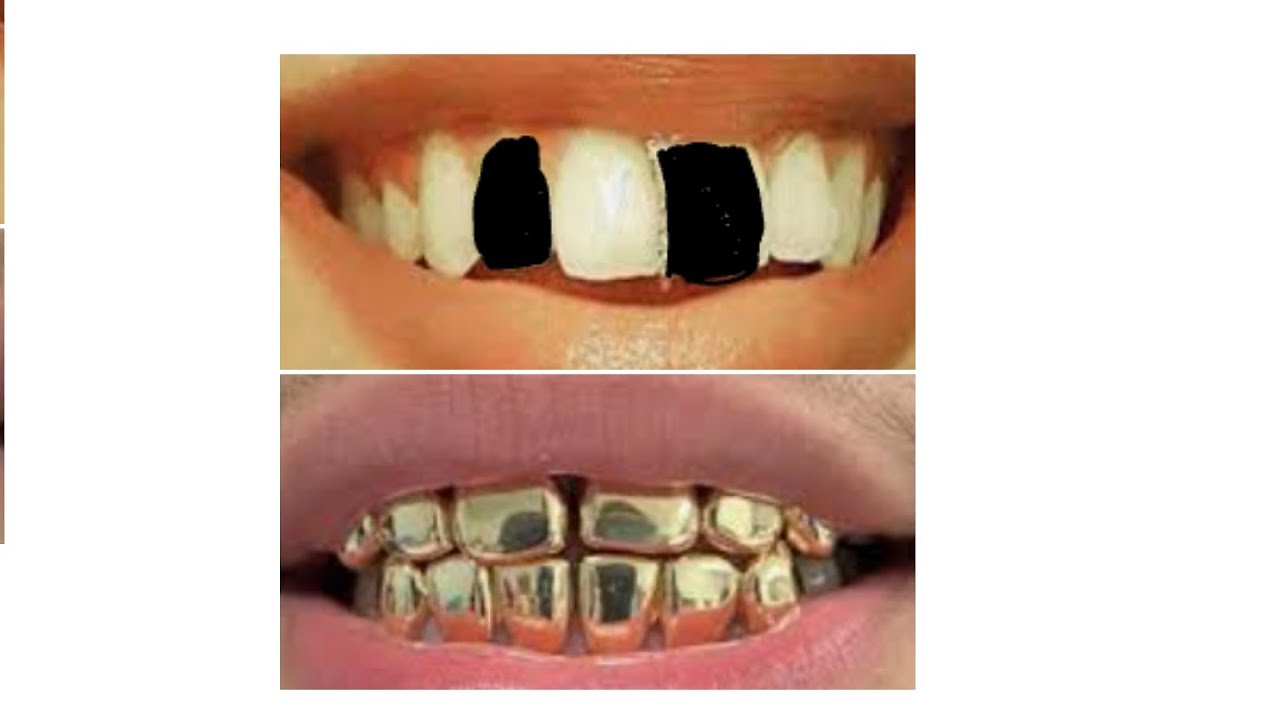 can you get gold grillz with missing teeth
