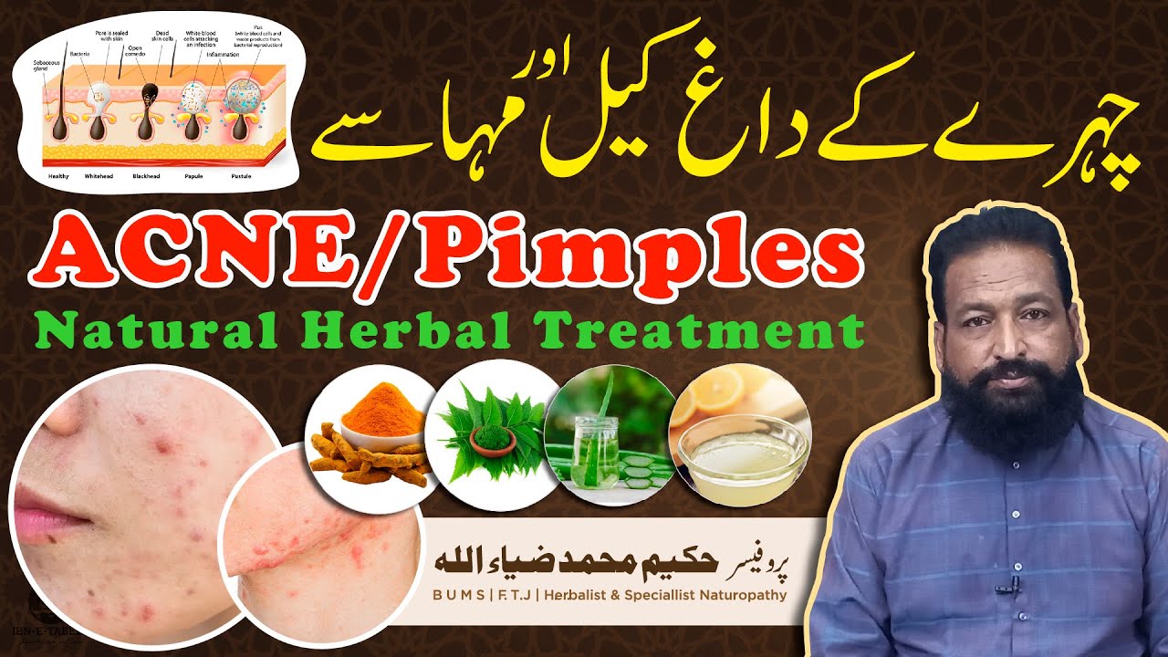 Acne - Pimples - Black & White Heads Natural Treatment - چہرے پر کیل مہاسے - IBN-E-TABEEB® IBNE00148