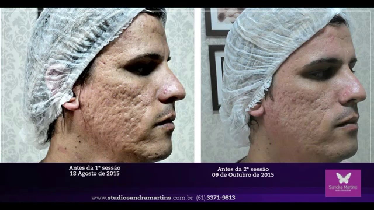 Microagulhamento rejuvenescimento, clareamento e cicatriz de acne
