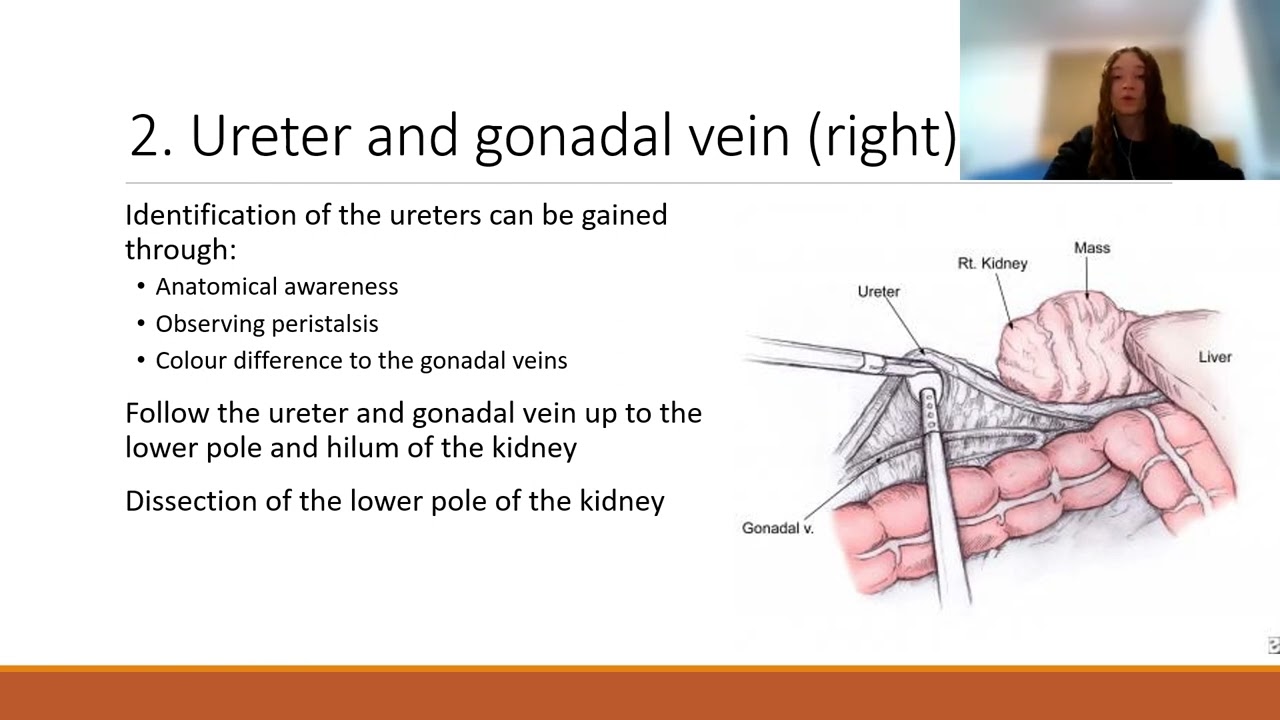 Laparoscopic radical nephrectomy  Sarah Lister