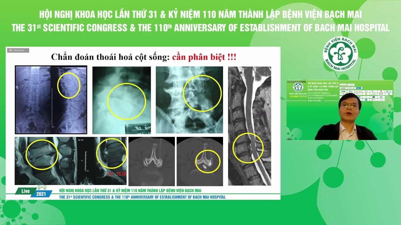Cập nhật chẩn đoán và điều trị bệnh thoái hóa khớp và cột sống TS BS  Bùi Hải Bình