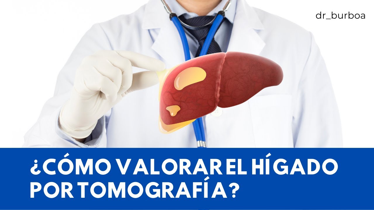 ESTUDIO DEL HÍGADO POR MEDIO DE TOMOGRAFÍA