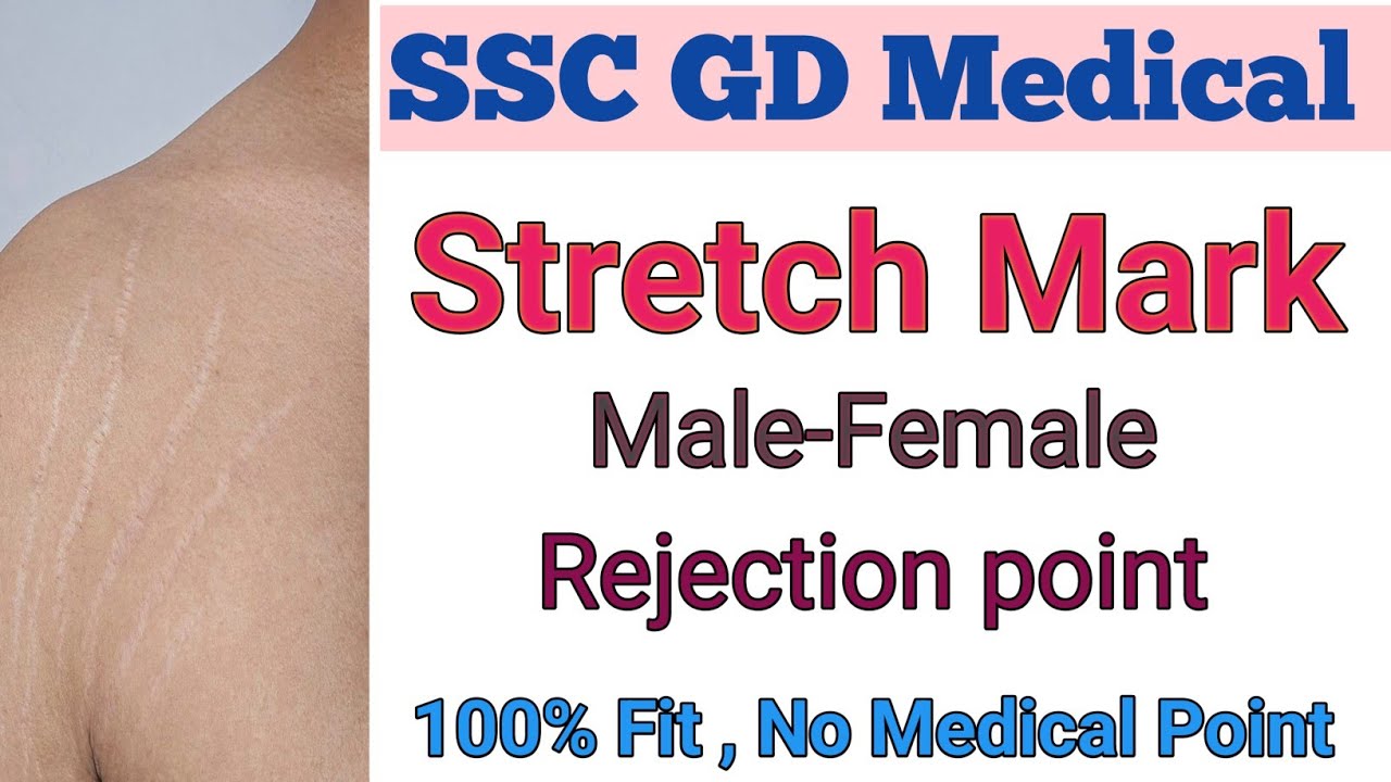 SSC GD Medical stretch marks | ssc gd medical Checkup| ssc gd medical test #sscgdmedical #sscgd 