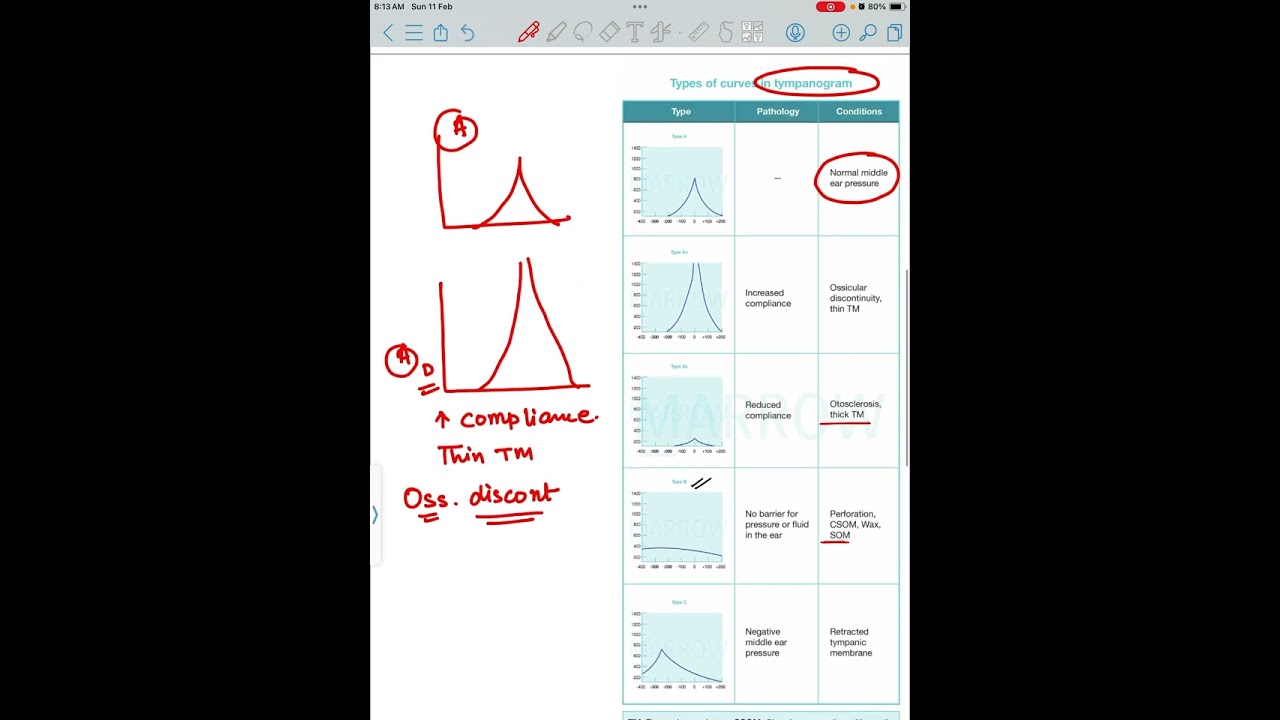Types of curves on tympanogram