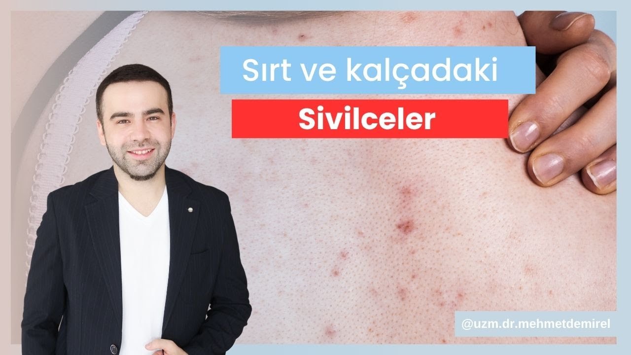SIRTTA VE KALÇADA NEDEN SİVİLCE ÇIKAR ?